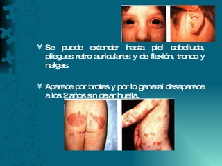Se puede extender hasta piel cabelluda, pliegues retro auriculares y de flexión, tronco y nalgas. Aparece por brotes y por lo general desaparece a los 2 años sin dejar huella. 