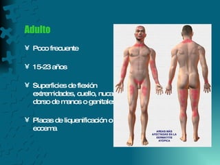 Adulto Poco frecuente  15-23 años Superficies de flexión  extremidades, cuello, nuca, dorso de manos o genitales. Placas de liquenificación o eccema 