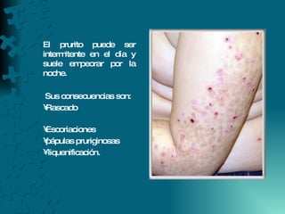 El prurito puede ser intermitente en el día y suele empeorar por la noche. Sus consecuencias son: Rascado Escoriaciones pápulas pruriginosas liquenificación. 