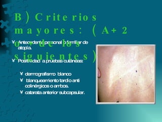 Antecedente personal o familiar de atopía. Positividad  a pruebas cutáneas: dermografismo  blanco  blanqueamiento tardío anti colinérgicos o ambos. catarata anterior subcapsular.  B) Criterios mayores:  ( A+ 2 o + de los siguientes) 