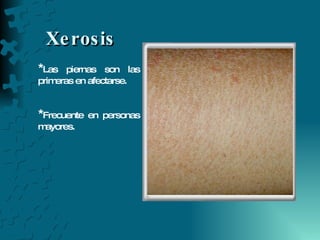 Xerosis * Las piernas son las primeras en afectarse.  * Frecuente en personas mayores. 