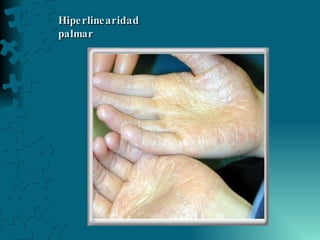 Hiperlinearidad palmar  