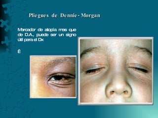 Pliegues de Dennie-Morgan  Marcador de atopía mas que de D.A., puede ser un signo útil para el Dx   