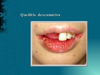 Queilitis descamativa 