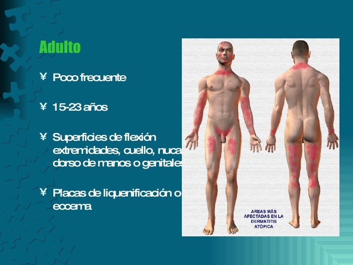 El aceite para la cabeza de la psoriasis