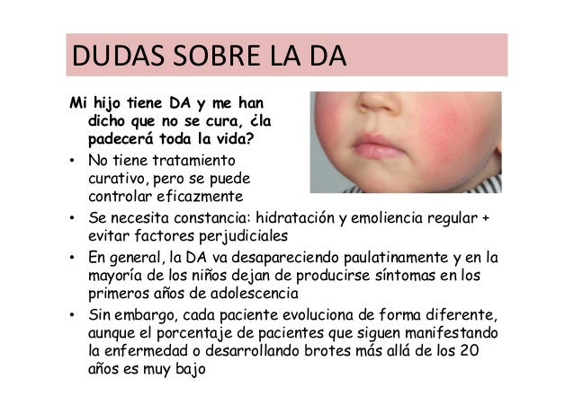 La eccema córnea sobre los dedos