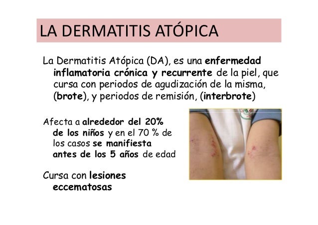 Que es posible curar la psoriasis