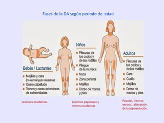 Fases de la DA según periodo de edad
Lesiones exudativas Lesiones papulosas y
menos exudativas
Pápulas, intensa
xerosis, alteración
de la pigmentación.
 