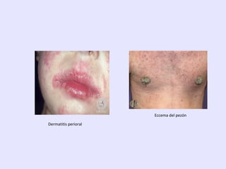 Dermatitis perioral
Eccema del pezón
 