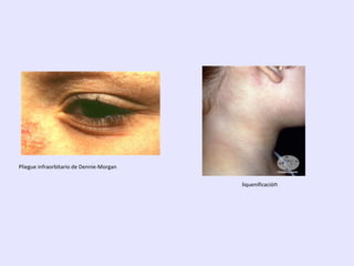 Pliegue infraorbitario de Dennie-Morgan
liquenificación
 