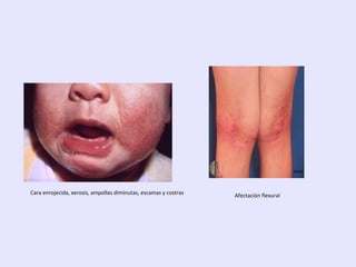 Cara enrojecida, xerosis, ampollas diminutas, escamas y costras Afectación flexural
 