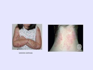 Lesiones costrosas
 