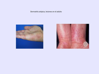 Dermatitis atópica, lesiones en el adulto
 