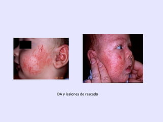DA y lesiones de rascado
 