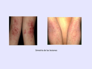 Simetría de las lesiones
 