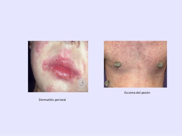 Tsiklosporin y las revocaciones a la psoriasis el precio
