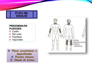 Placas eccematosas o
liquenificadas
Prurito intenso
Oleada de brotes
 