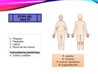  pápulas
 vesículas
 costras hemáticas
 Liquenificación
 