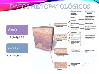 DATOS HISTOPATOLÓGICOS
Agudo
• Espongiosis
Crónico
• Acantosis
 