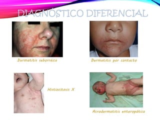 DIAGNÓSTICO DIFERENCIAL
Dermatitis seborréica Dermatitis por contacto
Histiocitosis X
Acrodermatitis enteropática
 