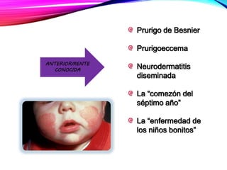 Prurigo de Besnier
Prurigoeccema
Neurodermatitis
diseminada
La “comezón del
séptimo año”
La “enfermedad de
los niños bonitos”
ANTERIORMENTE
CONOCIDA
 