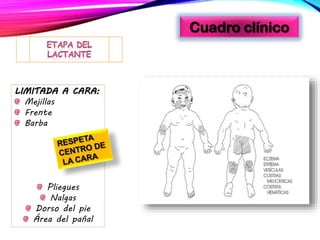 Cuadro clínico
LIMITADA A CARA:
Mejillas
Frente
Barba
Pliegues
Nalgas
Dorso del pie
Área del pañal
 