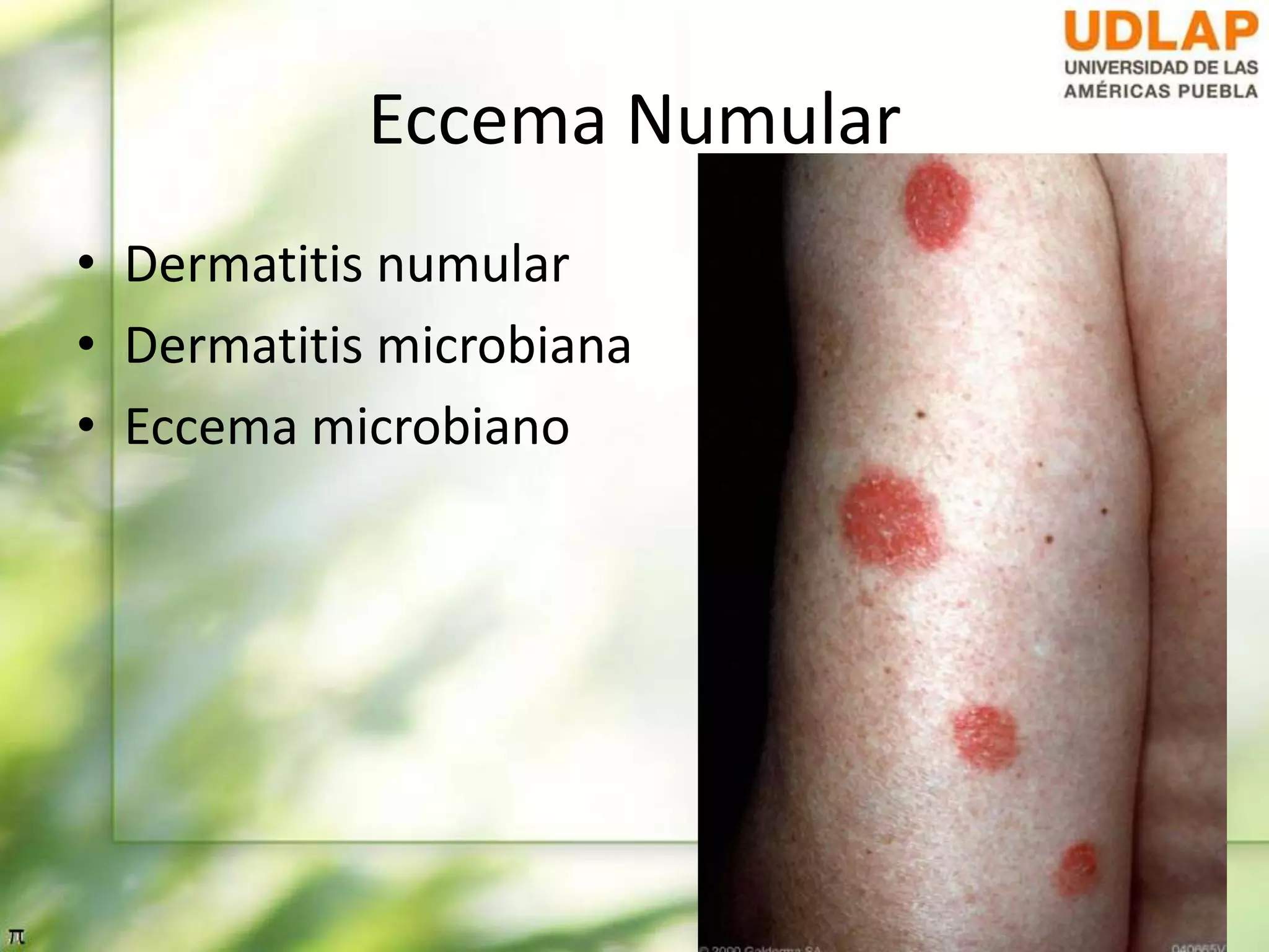 Dermatitis atópica y eccema numular (sin videos) | PPT