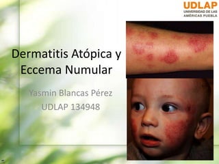 Dermatitis Atópica y
Eccema Numular
Yasmin Blancas Pérez
UDLAP 134948
 