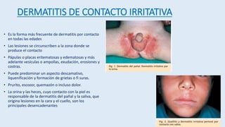 DERMATITIS DE CONTACTO IRRITATIVA
• Es la forma más frecuente de dermatitis por contacto
en todas las edades
• Las lesiones se circunscriben a la zona donde se
produce el contacto
• Pápulas o placas eritematosas y edematosas y más
adelante vesículas o ampollas, exudación, erosiones y
costras.
• Puede predominar un aspecto descamativo,
liquenificación y formación de grietas o fi suras.
• Prurito, escozor, quemazón o incluso dolor.
• La orina y las heces, cuyo contacto con la piel es
responsable de la dermatitis del pañal y la saliva, que
origina lesiones en la cara y el cuello, son los
principales desencadenantes
 
