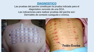 DIAGNOSTICO
Las pruebas del parche constituyen la prueba indicada para el
diagnóstico concreto de una DCA.
Las indicaciones para realizar pruebas del parche son:
Dermatitis de contacto subaguda o crónica,
 