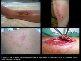 L. Host: A case of severe metal hypersensitivity post tibial plating. The Internet Journal of Orthopedic Surgery.
2009 Volume 11 Number 2.
 