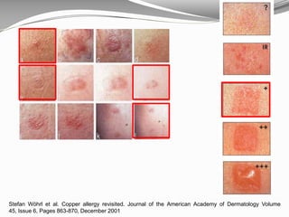 Stefan Wöhrl et al. Copper allergy revisited. Journal of the American Academy of Dermatology Volume
45, Issue 6, Pages 863-870, December 2001
 