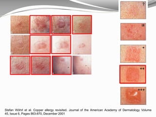 Stefan Wöhrl et al. Copper allergy revisited. Journal of the American Academy of Dermatology Volume
45, Issue 6, Pages 863-870, December 2001
 