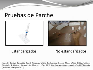 Pruebas de Parche
Estandarizados No estandarizados
Herro E. Contact Dermatitis: Part I. Presented at the Conferences On-Line Allergy of the Children’s Mercy
Hospitals & Clinicis. Kansas city, Missouri, USA. 2011 http://www.youtube.com/watch?v=6ICTSX-xqSM
(accessed 24 August 2013)
 