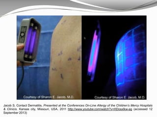 Jacob S. Contact Dermatitis. Presented at the Conferences On-Line Allergy of the Children’s Mercy Hospitals
& Clinicis. Kansas city, Missouri, USA. 2011 http://www.youtube.com/watch?v=HDosxIkw-ag (accessed 12
September 2013)
 