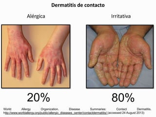 Dermatitis de contacto
Alérgica Irritativa
World Allergy Organization. Disease Summaries: Contact Dermatitis.
http://www.worldallergy.org/public/allergic_diseases_center/contactdermatitis/ (accessed 24 August 2013)
80%20%
 