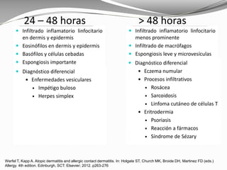 Werfel T, Kapp A. Atopic dermatitis and allergic contact dermatitis. In: Holgate ST, Church MK, Broide DH, Martinez FD (eds.)
Allergy. 4th edition. Edinburgh, SCT: Elsevier; 2012. p263-276
24 – 48 horas > 48 horas
 Infiltrado inflamatorio linfocitario
en dermis y epidermis
 Eosinófilos en dermis y epidermis
 Basófilos y células cebadas
 Espongiosis importante
 Infiltrado inflamatorio linfocitario
menos prominente
 Infiltrado de macrófagos
 Espongiosis leve y microvesículas
 Diagnóstico diferencial
 Enfermedades vesiculares
 Impétigo buloso
 Herpes simplex
 Diagnóstico diferencial
 Eczema numular
 Procesos infiltrativos
 Rosácea
 Sarcoidosis
 Linfoma cutáneo de células T
 Eritrodermia
 Psoriasis
 Reacción a fármacos
 Síndrome de Sézary
 