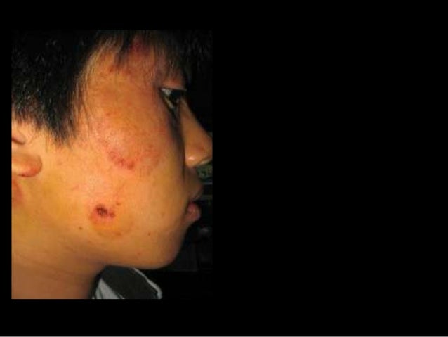 La fomentación a atopicheskom la dermatitis