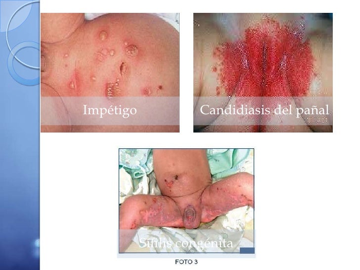 El trébol la psoriasis del prado