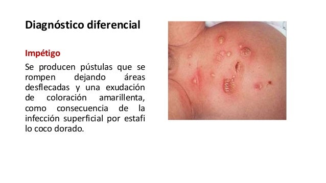 La eccema sobre las plantas de los pies que esta foto