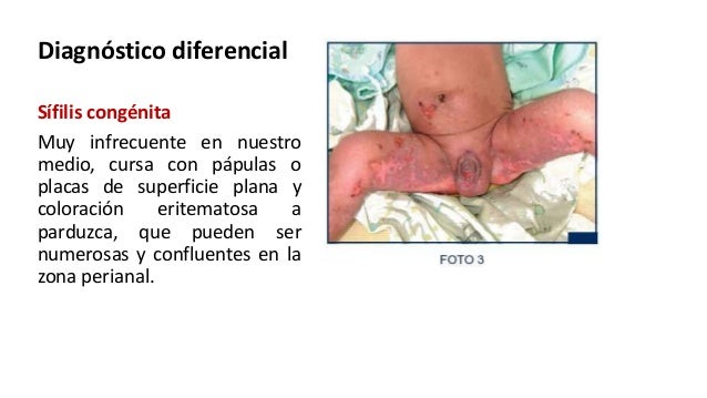 Dermatitis del pañal