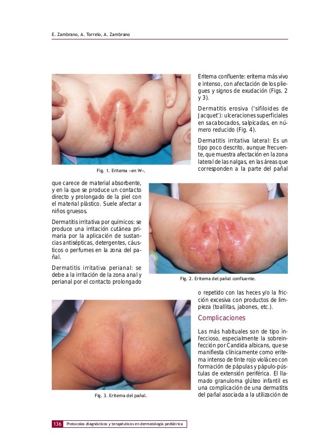 Como distinguir la eccema del hongo de la piel