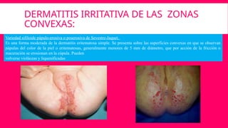 DERMATITIS IRRITATIVA DE LAS ZONAS
CONVEXAS:
Variedad sifiloide pápulo-erosiva o poserosiva de Sevestre-Jaquet.
Es una forma moderada de la dermatitis eritematosa simple. Se presenta sobre las superficies convexas en que se observan
pápulas del color de la piel o eritematosas, generalmente menores de 5 mm de diámetro, que por acción de la fricción o
maceración se erosionan en la cúpula. Pueden
volverse violáceas y liquenificadas
 