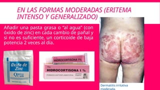 EN LAS FORMAS MODERADAS (ERITEMA
INTENSO Y GENERALIZADO)
Añadir una pasta grasa o “al agua” (con
óxido de zinc) en cada cambio de pañal y
si no es suficiente, un corticoide de baja
potencia 2 veces al día.
Dermatitis irritativa
 