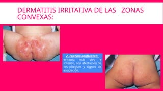 DERMATITIS IRRITATIVA DE LAS ZONAS
CONVEXAS:
2. Eritema confluente:
eritema más vivo e
intenso, con afectación de
los pliegues y signos de
exudación.
 