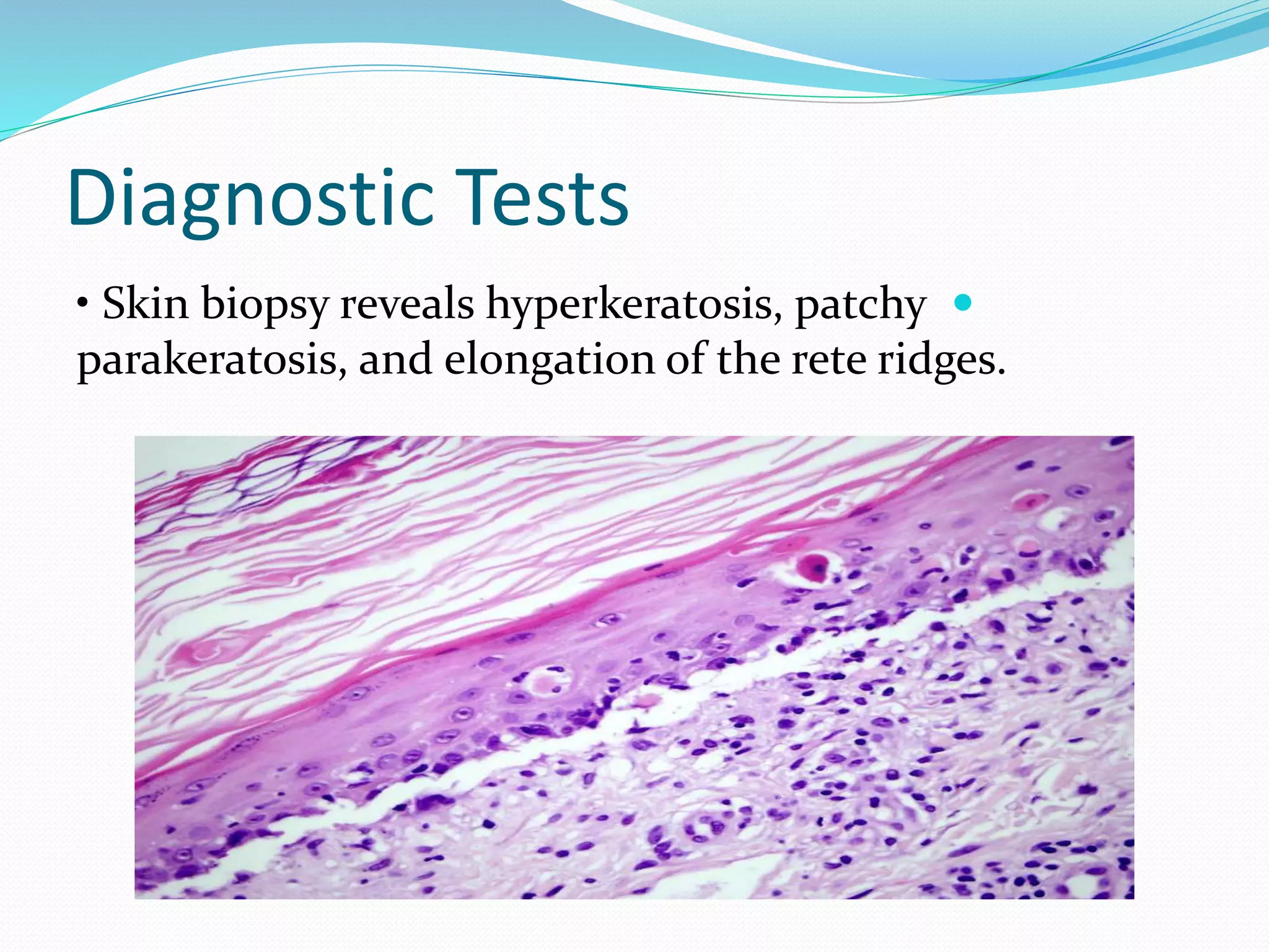 Diagnostic Tests

• Skin biopsy reveals hyperkeratosis, patchy
parakeratosis, and elongation of the rete ridges.
 
