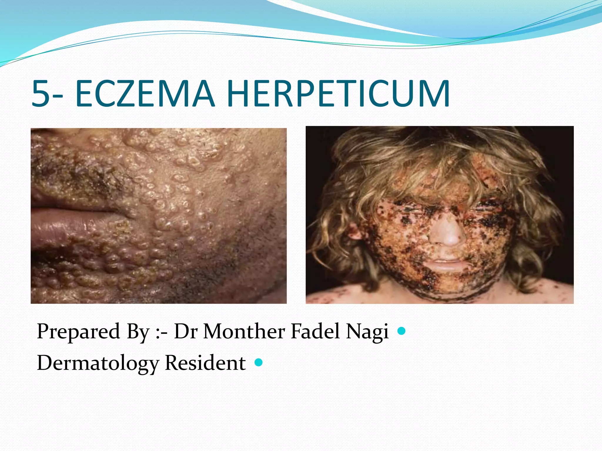 5- ECZEMA HERPETICUM

Prepared By :- Dr Monther Fadel Nagi

Dermatology Resident
 