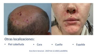 Otras localizaciones:
• Piel cabelluda • Cuello
• Cara • Espalda
Acta Derm Venereol . 2020 Feb 12;100(5):adv00056.
 