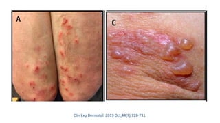 Clin Exp Dermatol. 2019 Oct;44(7):728-731.
 