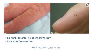 JAAD Case Rep. 2020 Sep; 6(9): 935–938.
• La púrpura acral es un hallazgo raro
• Más común en niños
 